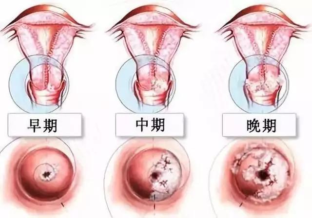 宫颈癌最早分期2025